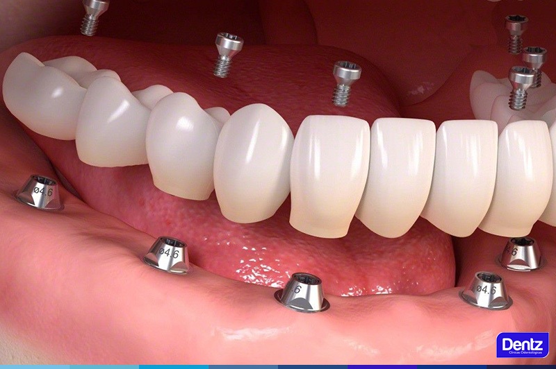 Dentz - Fachada Alphaville